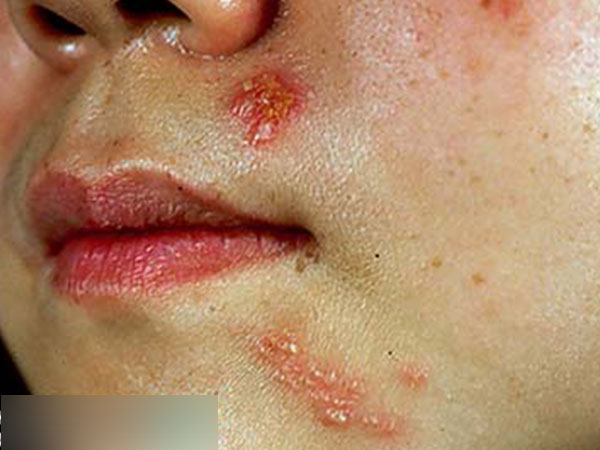 Mụn rộp sinh dục, chớ xem thường