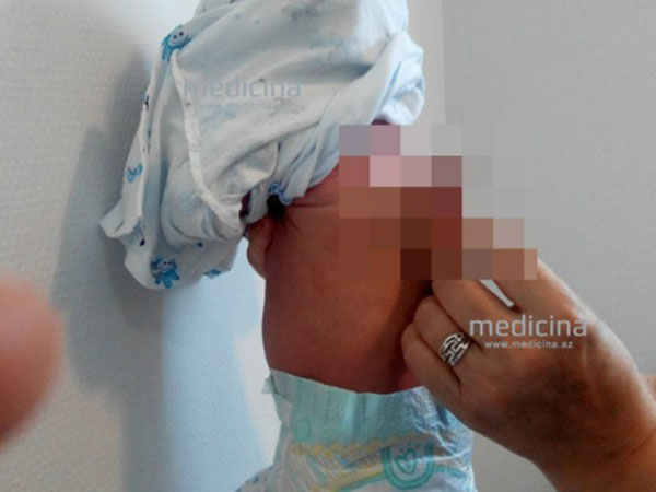 Bé trai chào đời có thêm một dương vật trên lưng