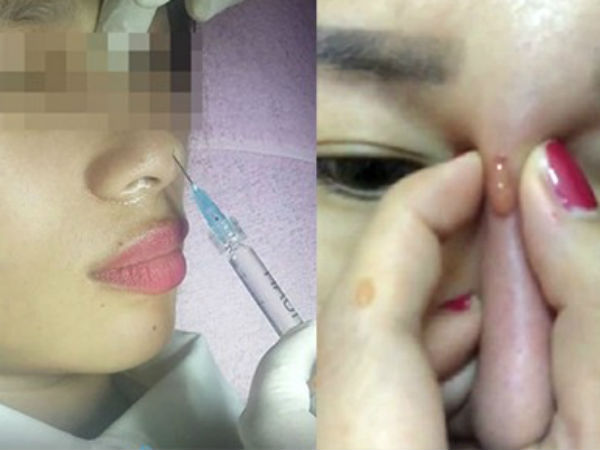 Vì sao tiêm filler nâng mũi lại bị mù mắt?