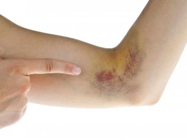 Dấu hiệu báo bệnh nguy hiểm khi vết bầm tím xuất hiện trên da mãi không khỏi