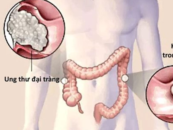 Bao lâu nên nội soi kiểm tra ung thư đại trực tràng?