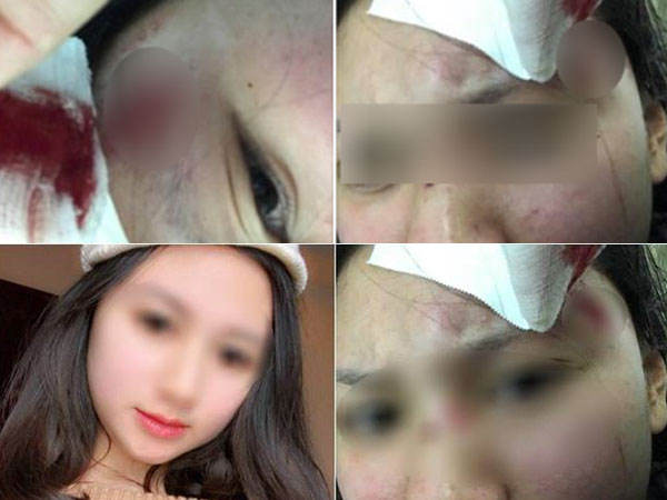 Hà Nội: Người vợ xinh đẹp 'tố' bị chồng đánh rách đầu, mang bầu cũng hành hung không tha