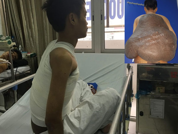 Ca mổ ngồi bóc khối u 15kg dính trên lưng người đàn ông