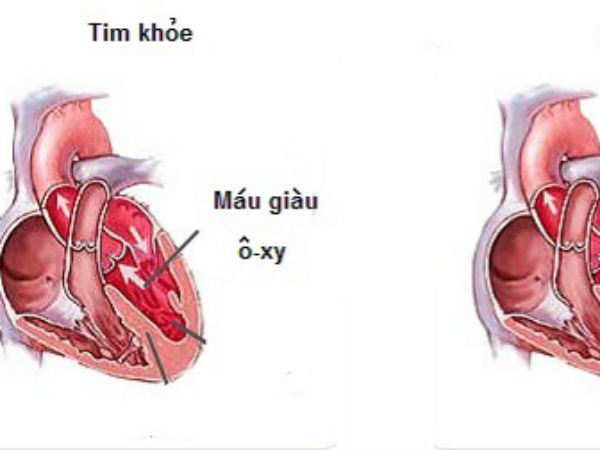 Dấu hiệu báo động nguy cơ suy tim bạn cần biết