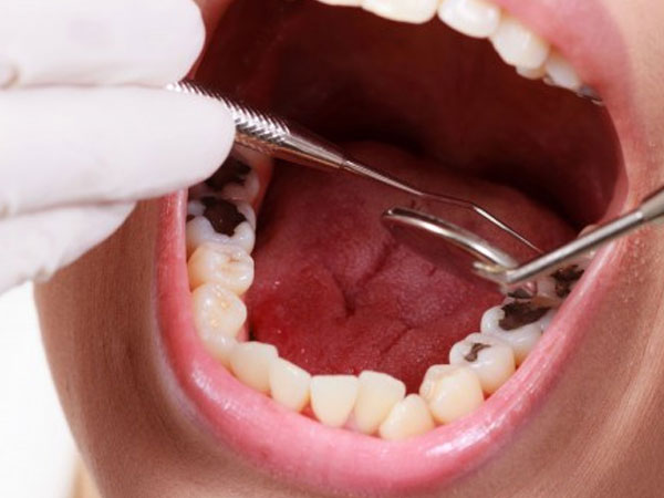 7 cách chữa sâu răng tại nhà hiệu quả