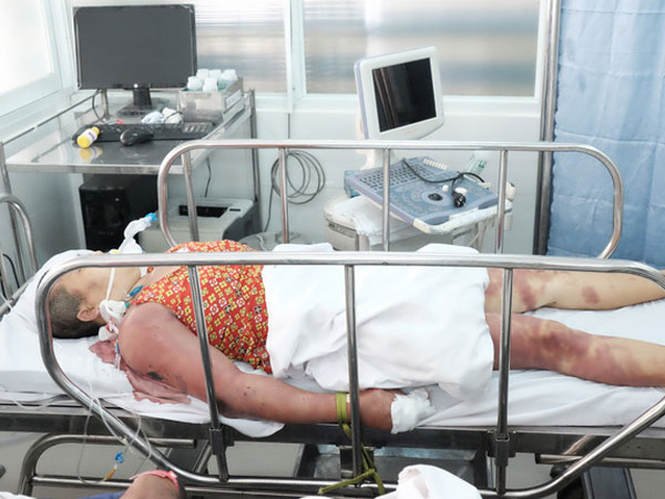 Nghi 'ma nhập' hai chị em bị thầy pháp dùng doi dâu đánh thâm tím toàn thân, khiến nguy kịch