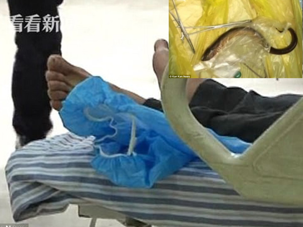 Chụp CT, bác sĩ phát hiện vật thể lạ trong bụng người đàn ông và không thể tin vào mắt mình khi lấy ra