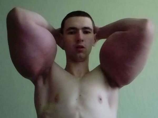 Muốn được như Popeye, tiêm dầu vào bắp tay để thành lực sỹ