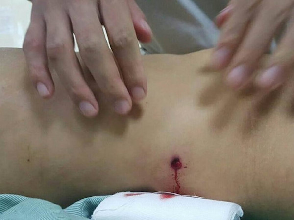 Đang đi đường, người phụ nữ bị đạn bắn thủng bụng