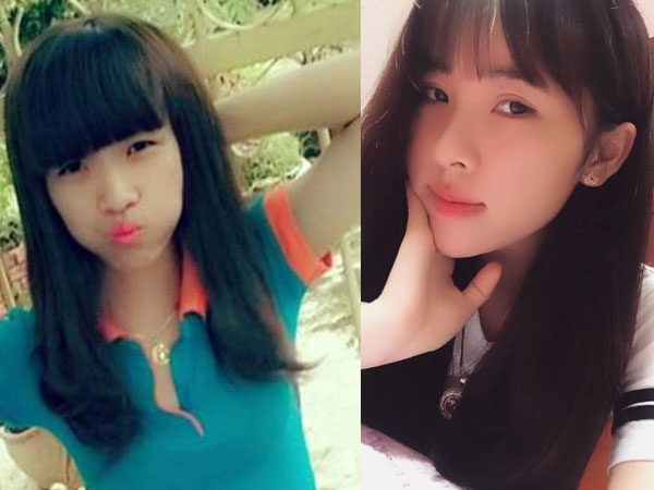 Bốn lần phẫu thuật thẩm mỹ giúp cô gái xấu xí hóa xinh đẹp