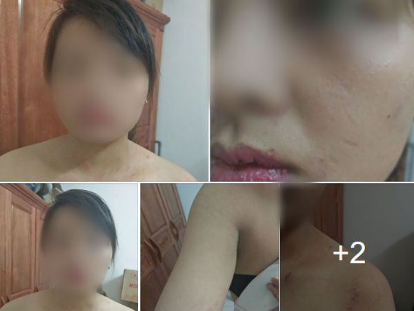 Hà Nội: Từ chối nộp hết tiền kiếm được hàng tháng cho mẹ chồng, người phụ nữ bị nhà chồng đánh thâm tím khắp người