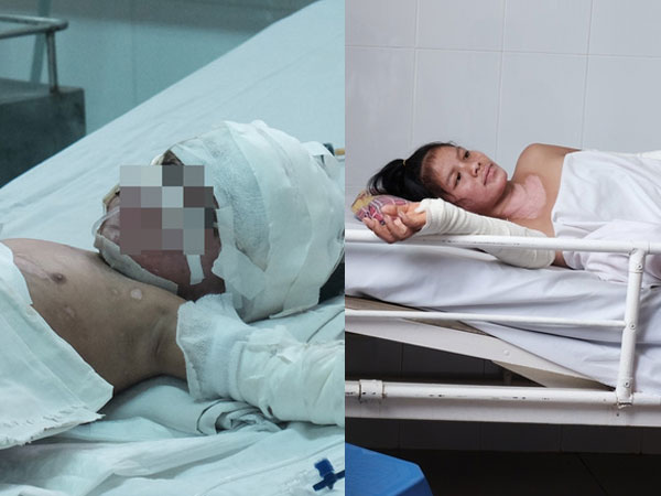 Nến rớt xuống bình xăng dưới giường, hai mẹ con thai phụ bỏng nặng, chồng chưa cưới ôm tiền ủng hộ bỏ trốn