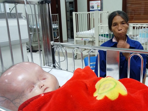 Vụ bé trai có cái đầu to khác lạ bị bố bỏ mẹ con đi lấy vợ khác: Tiên lượng xấu, gia đình xin về