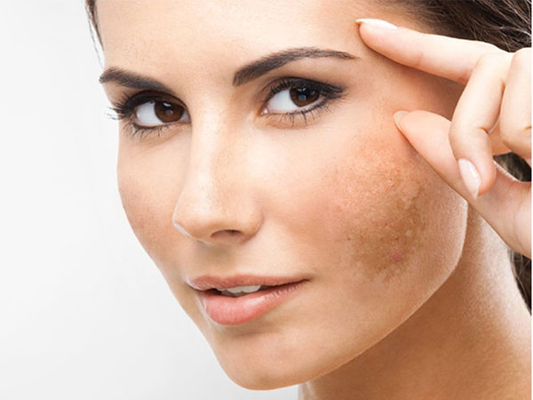 Những lưu ý cực kỳ quan trọng cho làn da bị nám, ai không biết sẽ tiếc hùi hụi!