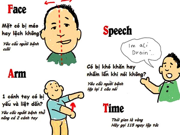 8 thắc mắc phổ biến về đột quỵ bạn nên ghi nhớ