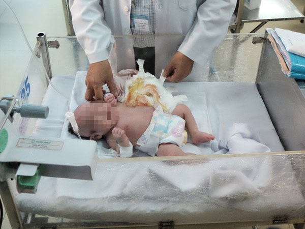 TP.HCM: Vừa chào đời, bé gái đã mang khối u khủng trên cơ thể khiến tính mạng nguy hiểm