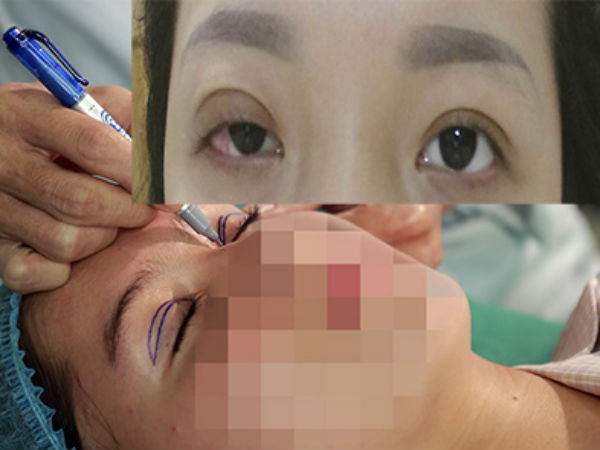 Cô gái vĩnh viễn không thể nhắm mắt sau khi cắt mí làm đẹp