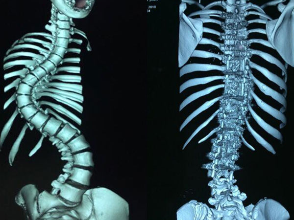 Thiếu nữ có cột sống uốn lượn như xương rắn
