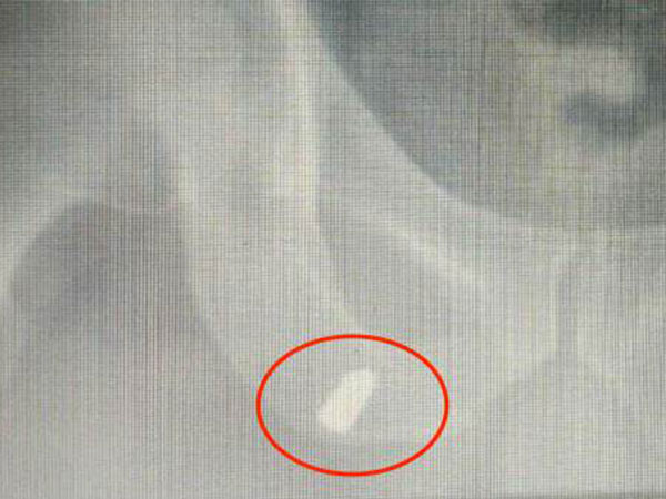Đạn lạc găm trúng đùi người đi làm ruộng ở Nghệ An