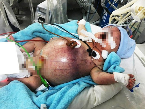 Tưởng không thể qua khỏi, bé trai thủng ruột từ trong bụng mẹ được cứu sống kỳ diệu