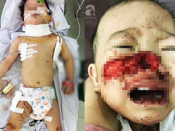 Mẹ lo làm việc dưới bếp, con trai bị chó nhà cắn thủng khí quản