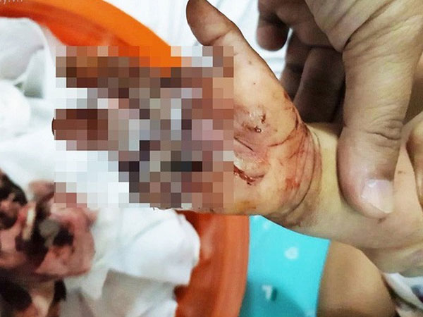 Bình Dương: Bé trai 2 tuổi bị sên xe máy quấn đứt lìa bàn tay