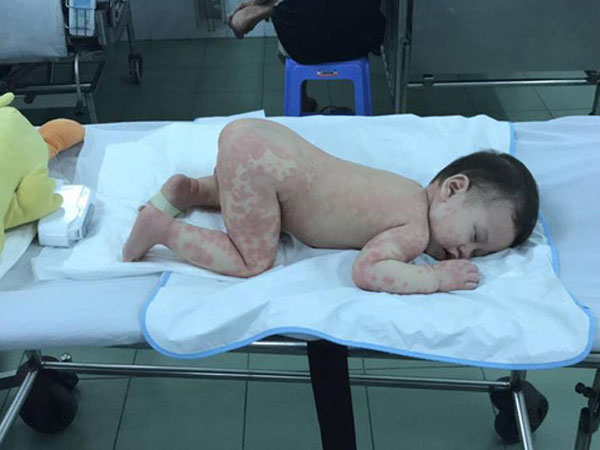 Mẹ tưởng con chỉ bị viêm phổi nhưng cuối cùng lại mắc bệnh lạ nguy hiểm