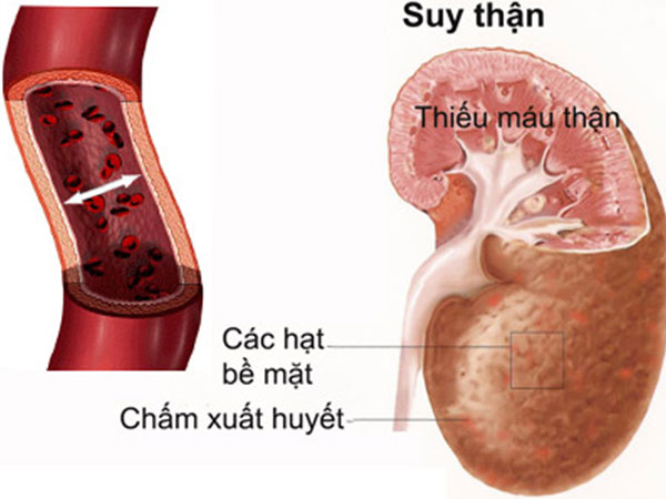 Bệnh thận ảnh hưởng tới tình dục thế nào?