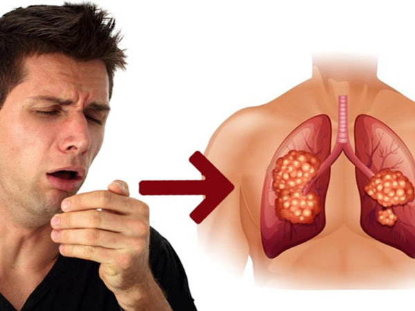 Ho trong bao lâu thì bạn nên đi khám để phòng ngừa bệnh ung thư phổi?