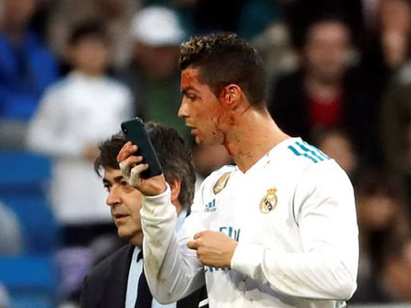 Ronaldo chảy máu đầm đìa trên mặt sau pha ghi bàn