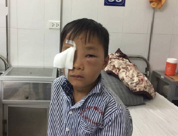 Bé trai 8 tuổi bị chó cắn thủng mắt, bố mẹ nhìn thấy nhưng không kịp trở tay