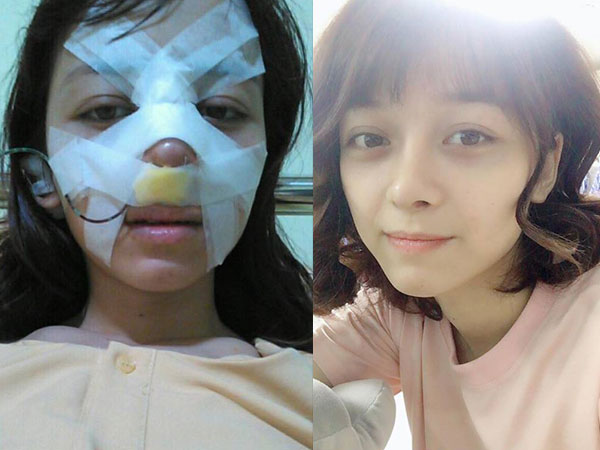 Trải nghiệm kinh hoàng của cô gái trẻ lần đầu nâng mũi sẽ khiến nhiều người nghĩ lại nếu định 'dao kéo'