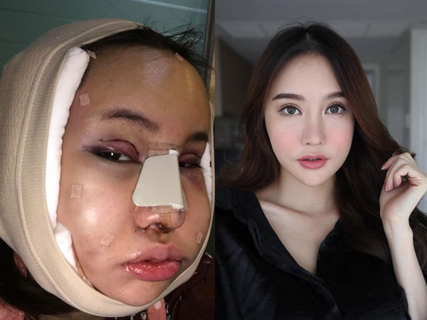 Hot Facebooker Thái Lan 'bật mí' quá trình phẫu thuật thẩm mỹ đau đớn nhưng trả về kết quả đẹp xuất sắc