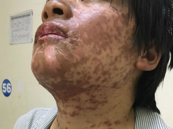 Cô gái bị biến dạng khuôn mặt vì tự ý dùng thuốc kháng sinh