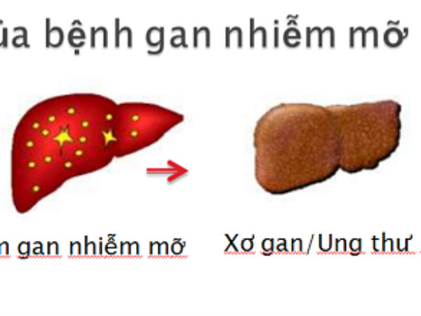 Gan nhiễm mỡ gây nhiều bệnh nguy hiểm
