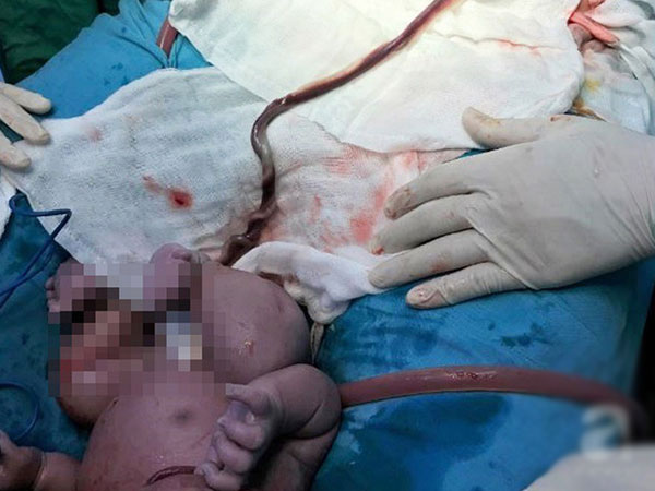 Cần Thơ: Sản phụ 29 tuổi suýt mất con vì tình trạng tắc mạch rốn trong tử cung rất hiếm gặp