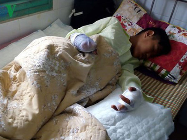 Một thiếu niên mất hai bàn tay vì pháo nổ