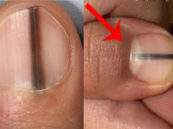 Cảnh giác ngay khi thấy trên móng tay có dấu hiệu bất thường này