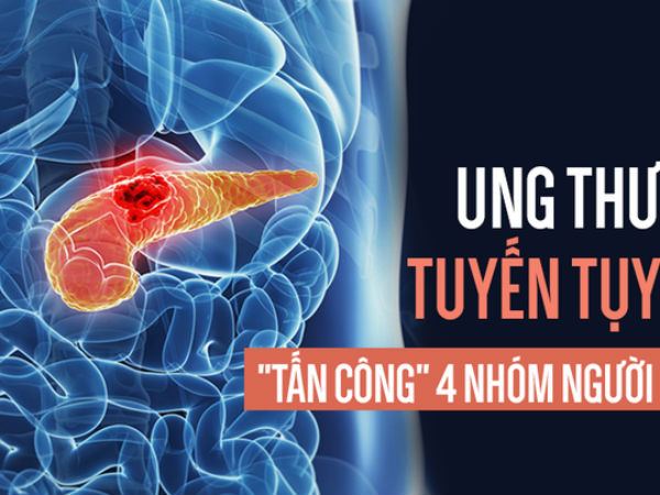 Ung thư tụy rất nguy hiểm vì khó chữa, ai có 4 đặc điểm này hãy đặc biệt cẩn thận