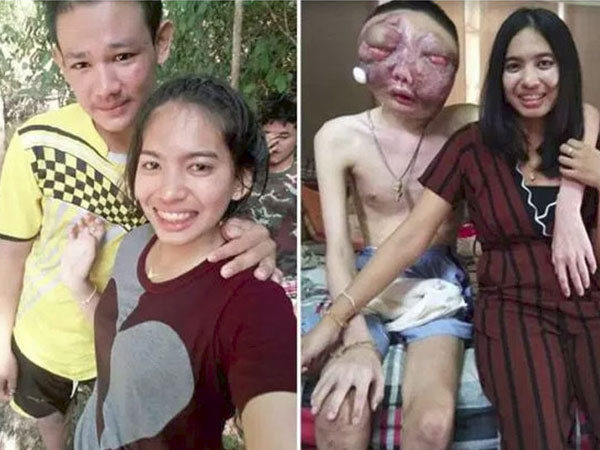 Dù chồng bị ung thư với khuôn mặt biến dạng, vợ vẫn một lòng ở bên chăm sóc: '3 năm, em vẫn yêu anh như ngày đầu'