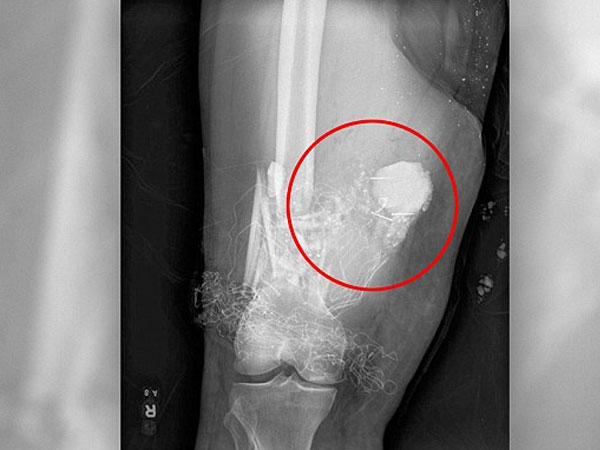 Bác sĩ gọi đội phá bom để gỡ pháo trong chân bệnh nhân