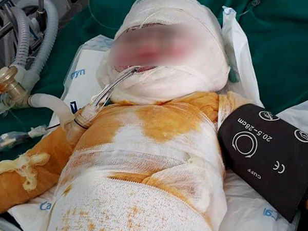 Con ngã vào hố vôi đang sôi, mẹ tuột da, thịt thò tay kéo con lên