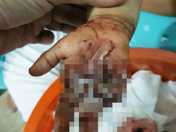 Long An: Bé trai 3 tuổi bị dây sên xe máy cuốn đứt lìa hai ngón tay