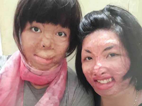 2 người phụ nữ bị chồng tẩm xăng đốt 'nắm tay' nhau tô hồng cuộc sống