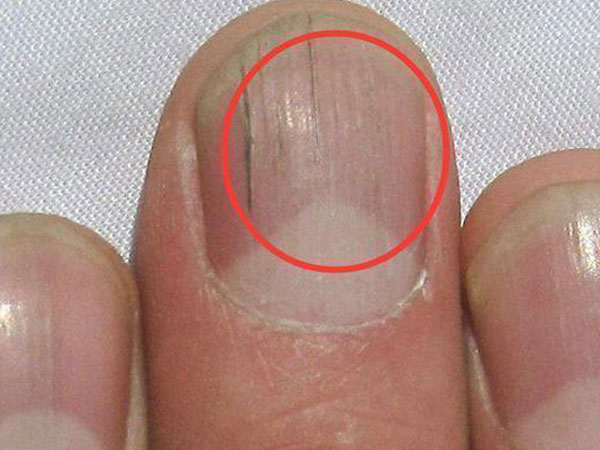 Nếu gan sinh bệnh hoặc nhiễm độc, móng tay sẽ có 3 thay đổi bất thường dễ nhận biết