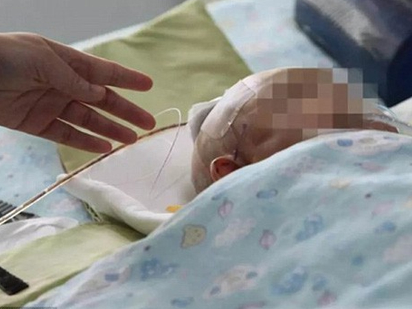 Bị táo rơi trúng đầu, bé 3 tháng tuổi nứt sọ