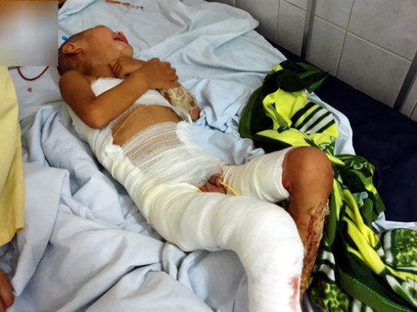Đòi đến trường đón anh tan học, bé trai 3 tuổi bất ngờ vấp, ngã cả người vào nồi nước sôi bên đường