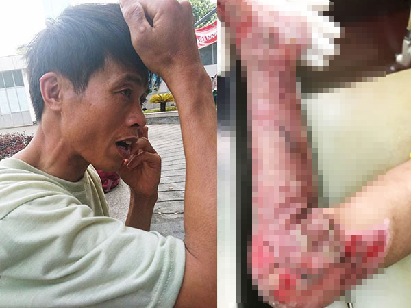 Thương tâm cha lóc da cứu con trai 3 tuổi bỏng toàn bộ cơ thể vì cháy nhà