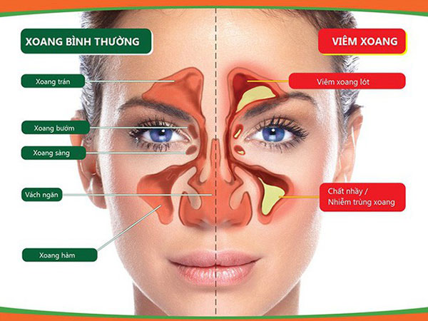 Cậu bé mất mạng vì viêm xoang, nhiều mẹ hoang mang, lo lắng