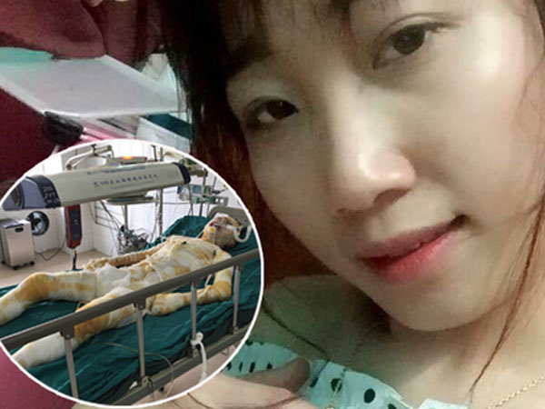 Nghi do mâu thuẫn bạn bè, cô gái xinh đẹp bị tẩm xăng thiêu sống trong lúc ngủ, mức độ bỏng toàn thân 92%